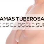 Mamas tuberosas: ¿qué es el doble surco?