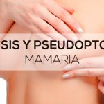 Ptosis y pseudoptosis mamaria