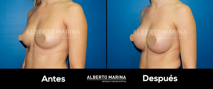caso antes y despues aumento de pecho en Valencia Dr Marina